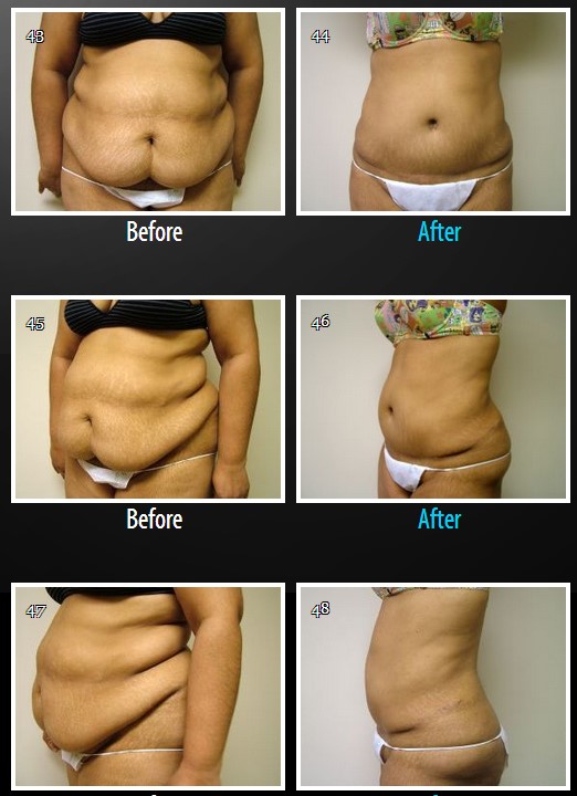 Tummy-Tuck-Abdominoplasty-Before-and-After-Photos-las-vegas