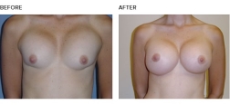 Smith Surgery-Corrective breast surgery options, before and after photo of patient