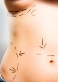 Smith Surgery-Woman prepped for surgery 